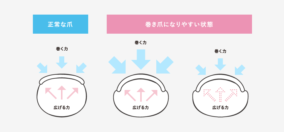 「巻き爪の発生メカニズムに即した治療方法とは」