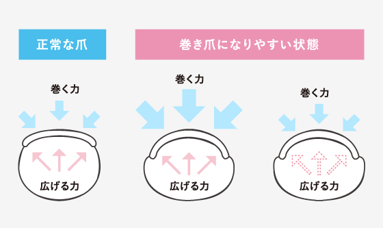 「巻き爪の発生メカニズムに即した治療方法とは」